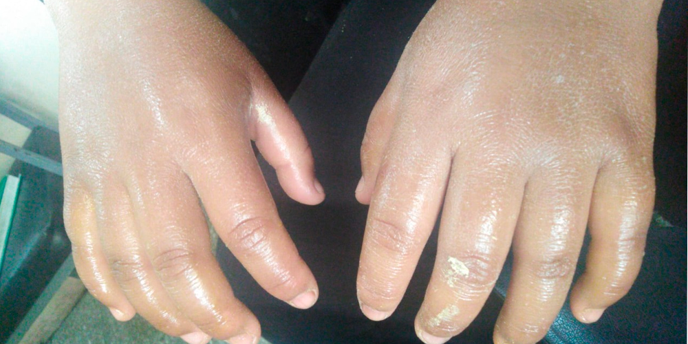 Sereno de Trujillo quedó herido luego que ambulante le lanzó ácido muriático