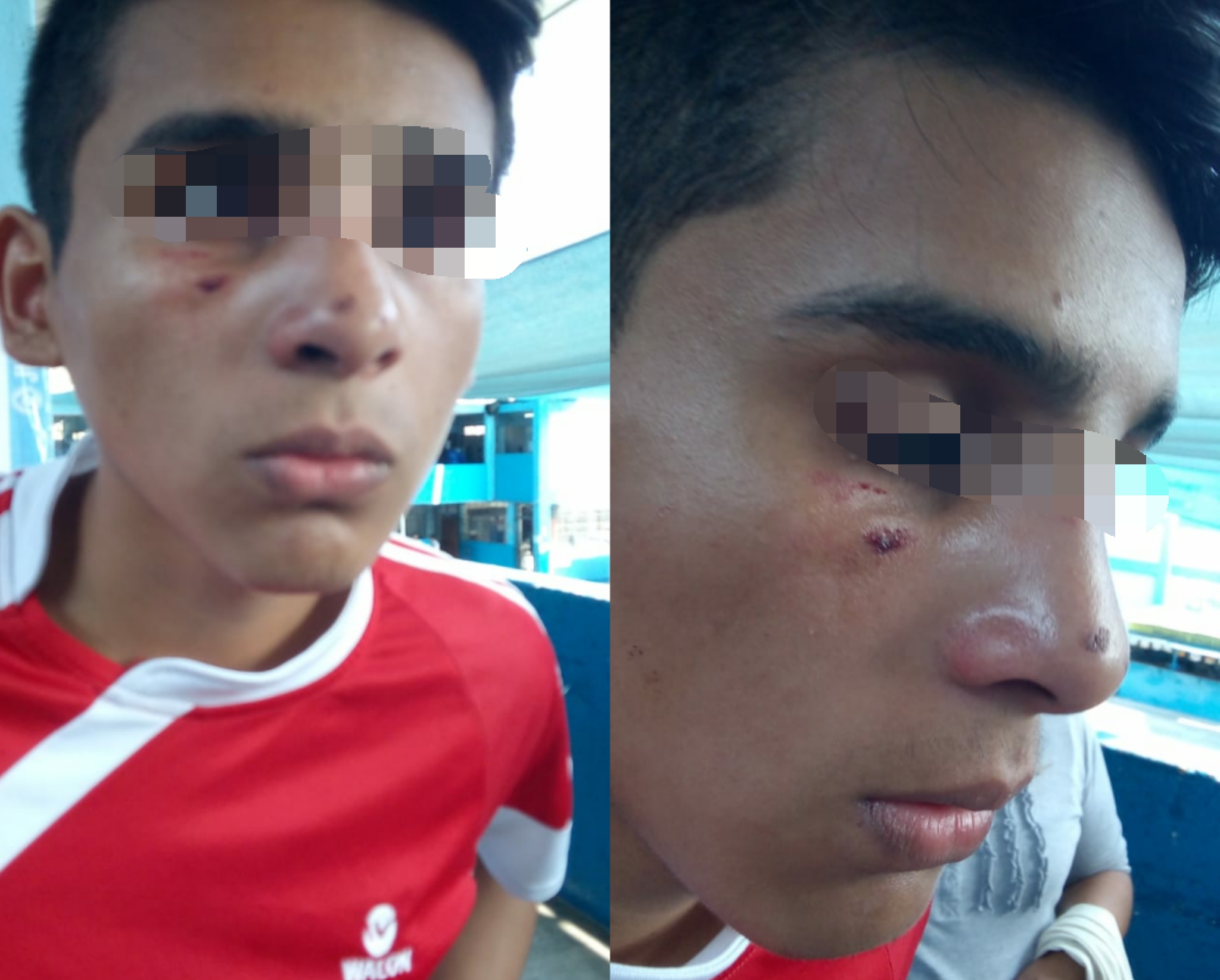 Trujillo: Escolar termina con la nariz rota luego de pelear con su compañero de colegio