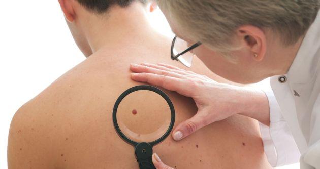 Campaña “El Día del Lunar” se realizará del 31 de enero al 10 de febrero en varias ciudades del país