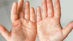 OMS: más de la mitad de los países sufrirán alto riesgo de brotes de sarampión