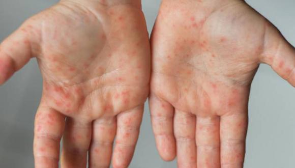 A 22 se elevaron los casos de viruela del mono en La Libertad