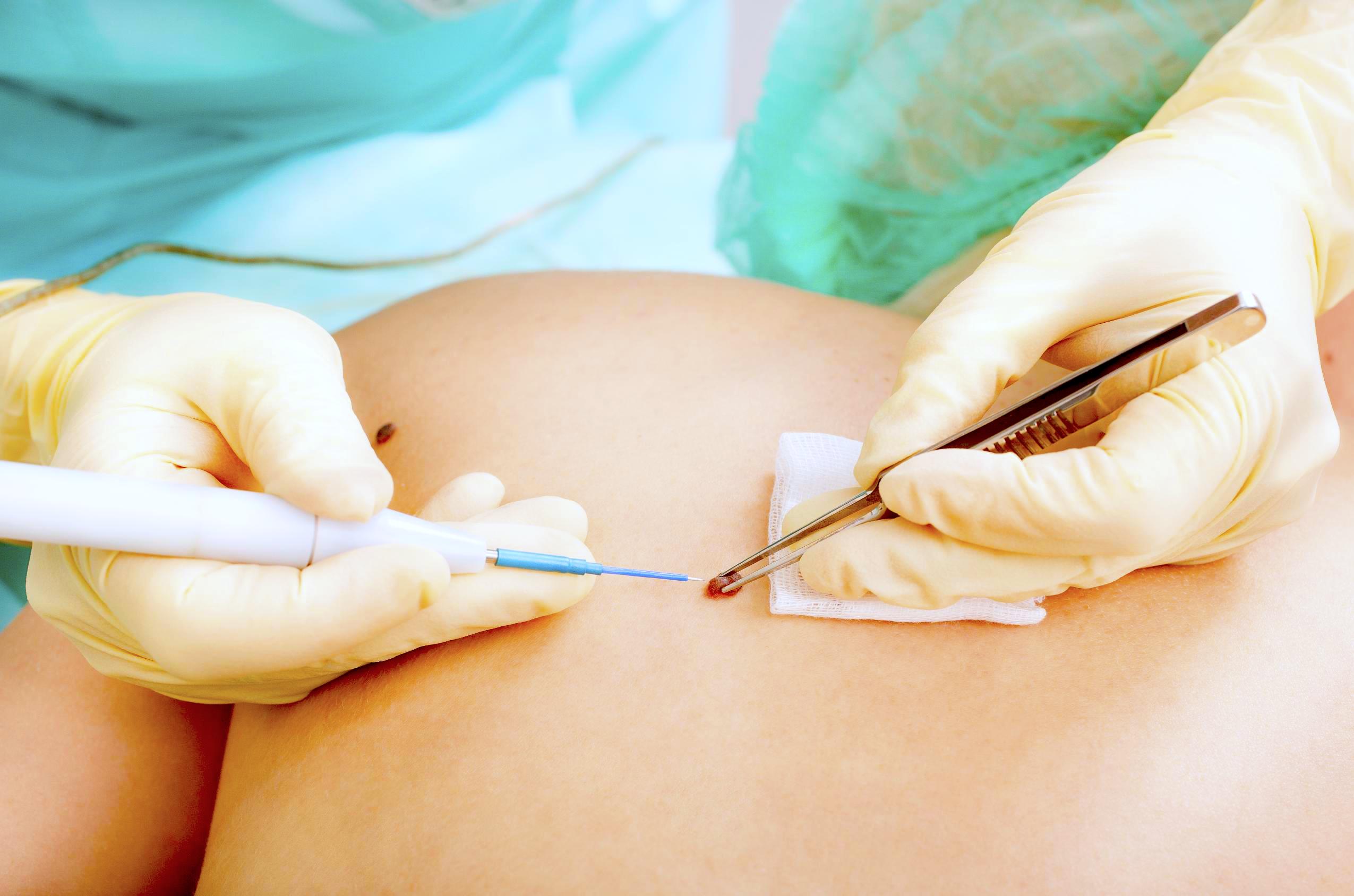 La quemadura solar puede generar a futuro cáncer de piel