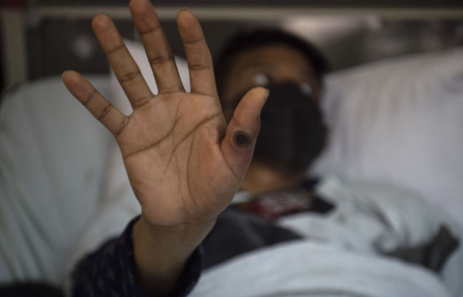 Minsa actualiza norma técnica de salud para prevención y manejo de la viruela del mono 