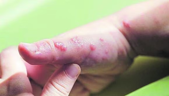 Paciente de 33 años con viruela del mono fallece por asfixia en La Libertad 