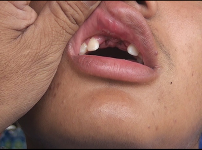 Alumno de colegio San Juan pierde dos dientes en pelea escolar