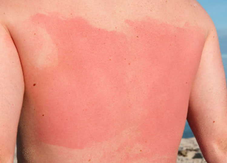  Quemadura solar en la niñez podría generar cáncer de piel, advierten especialistas