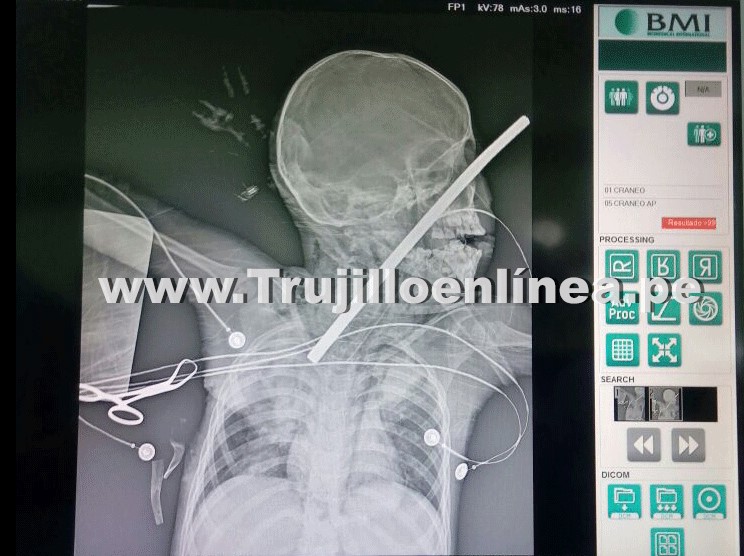 Chao: niño de cinco años se debate entre la vida y la muerte al ser atravesado por un fierro 