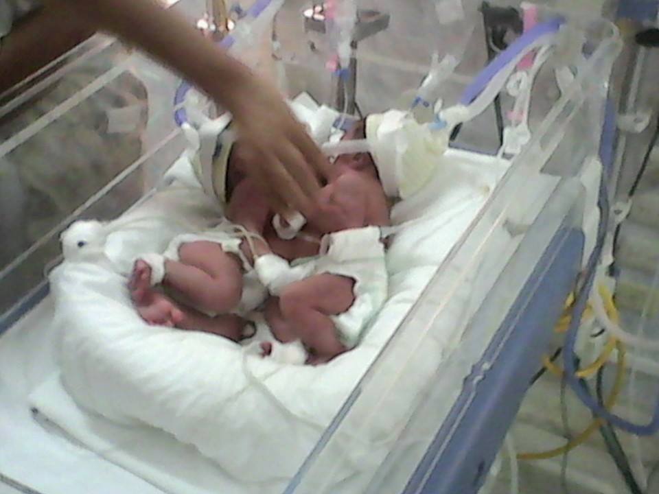 Siamesas que nacieron en el Hospital Belén fueron trasladadas a Lima  