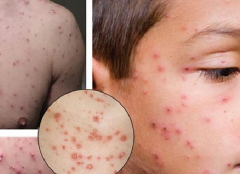  Trujillo: refuerzan vigilancia de casos de varicela infantil para evitar más muertes