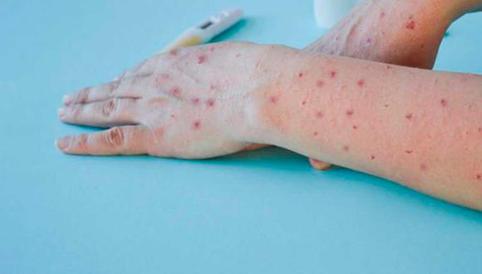 La Libertad: a 42 se elevan los casos de la viruela del mono